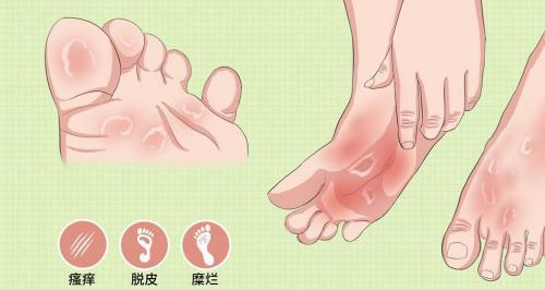 氟康唑軟膏多少錢一盒（腳氣和腳臭是一碼事兒嗎）