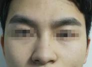 九院隆鼻多少钱（男女隆鼻的相同与差异）