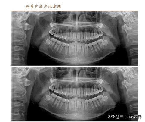 单个牙齿牙套多少钱（口腔科技）