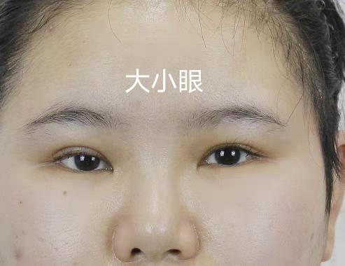 整眼睛大概要多少钱（12月13日单侧上睑下垂修复）