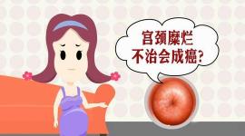 宫颈糜烂手术价格表（宫颈糜烂要不要治疗）