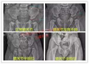 蛙式支架多少錢（發(fā)育性髖關(guān)節(jié)脫位致殘率高）