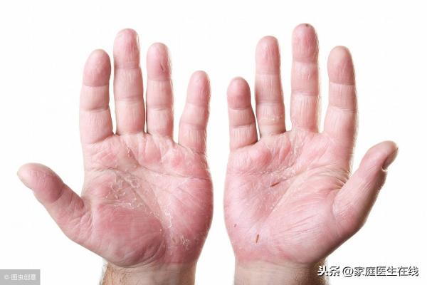 旺爽洗腳皂多少錢一塊（手腳干裂起皮）