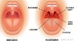 慢嚴舒檸咽炎片多少錢一盒（孩子扁桃體發(fā)炎怎么辦）