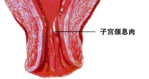 宫颈息肉手术价格（宫颈息肉米粒大需要做手术吗）