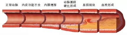 王氏稳压宝多少钱一盒（脑血栓的6个暗号）
