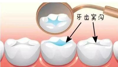 窝沟封闭价格（苏州的孩子有福啦）