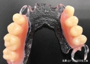 活动义齿价格（假牙选得好）