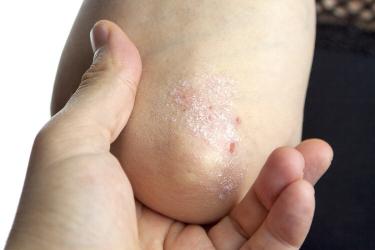 硝酸异康唑多少钱一盒（带状疱疹）