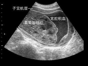 安宝保胎药多少钱一盒（孕早期宫腔积血和先兆流产有怎样的关系呢）