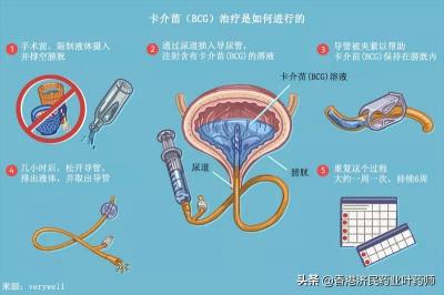 膀胱灌注卡介苗价格（免疫治疗卡介苗）