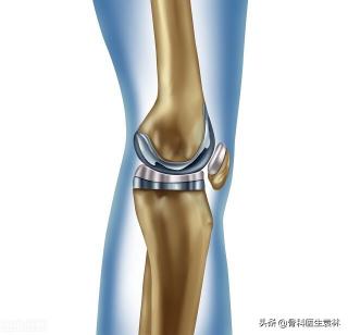 股骨头材质和价格（股骨头坏死手术费用大约是多少）