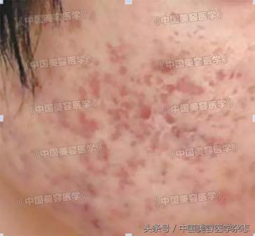 点阵激光价格（两种点阵激光治疗痤疮凹陷性瘢痕疗效对比）