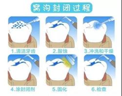 窝沟封闭价格（做窝沟封闭的费用是多少）