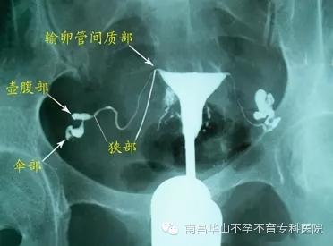 碘水造影多少钱一次（南昌华儿山孕育课堂）