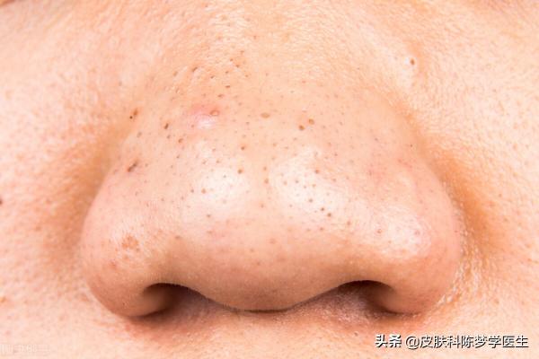 克尤王乳膏多少錢（長粉刺）