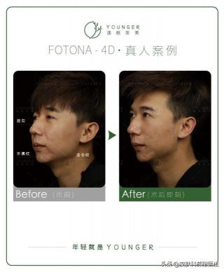 超皮秒价格（单打已经火遍娱乐圈的fotona）
