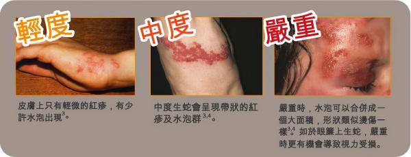 阿昔洛韦软膏价格（它带来的神经痛被称为）