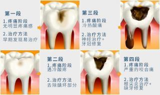 牙齿杀神经价格（抽完牙神经后）