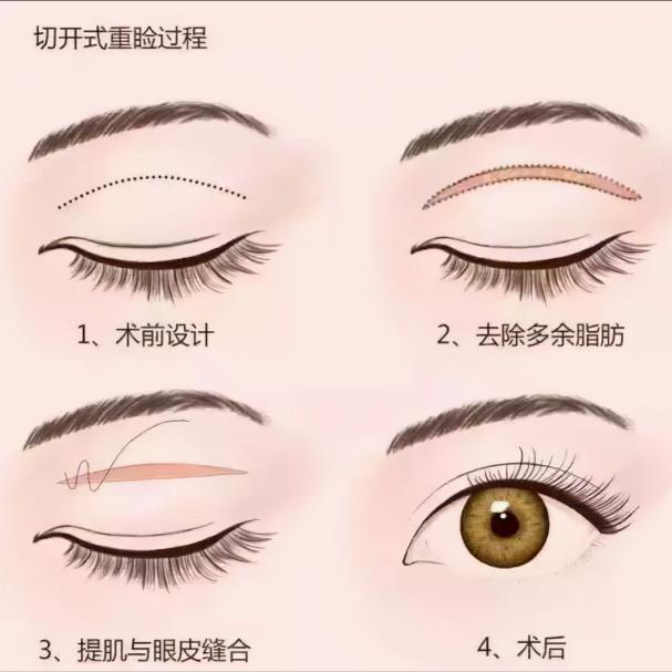 肿眼泡手术价格（肿眼泡可以单纯去脂吗）