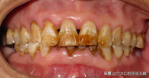 烤瓷牙與全瓷牙的價格(全瓷牙和烤瓷牙的區別)