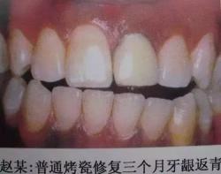 钴铬合金烤瓷牙价格表（牙医教你如何选择烤瓷牙的材料）