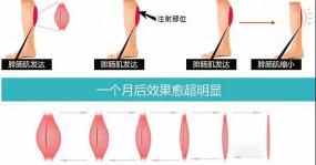 整容瘦腿针价格（如何科学有效瘦小腿）