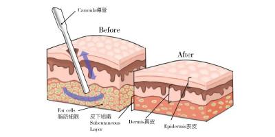 面部抽脂减肥的价格多少（韦敏科普丨面部吸脂可以改善哪些面部问题）