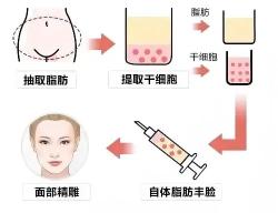 脸部填充价格（可用于面部填充的材料都有哪些）