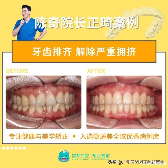 牙齿拥挤牙齿矫正价格（牙齿拥挤）