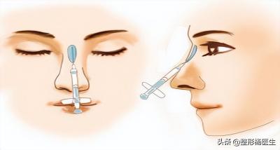 硅胶隆鼻价格（注射隆鼻）