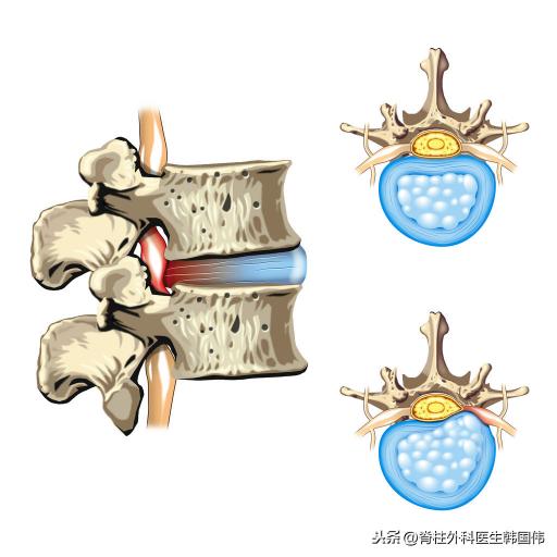 腰椎治疗仪价格（腰突患者怎样在家治疗）