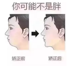 隐适美矫正价格2万五（10个矫正9个被坑）