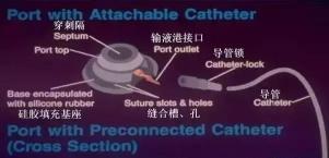 输液港价格（哪些人适合植入静脉输液港）