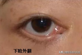 眼球突出整形价格（从整形医生的角度说一说）