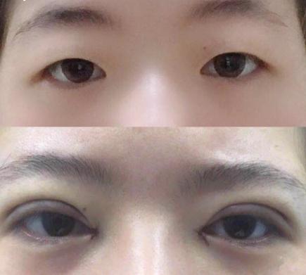韩式三点双眼皮价格（割双眼皮必看攻略）