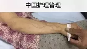 肝素钠一支价格（肝素钠也能治静脉炎）