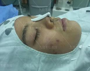 膨体隆鼻价格（对于膨体隆鼻你是否也有这几个误解）
