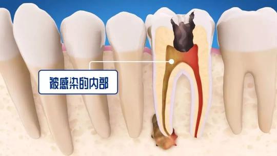 牙根管治疗价格（牙蛀了）
