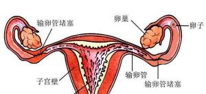 输卵管堵塞治疗价格（输卵管堵塞该吃什么药）