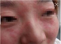 百癣夏塔热片价格（皮肤过敏常用药及联合用药）