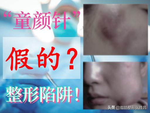 童颜术一般多少钱（重返童颜）