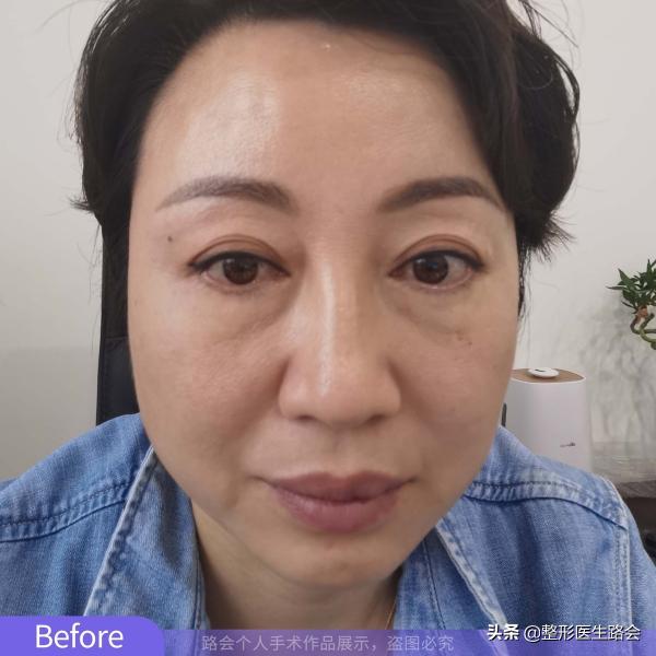 做祛除眼袋要多少錢(40)