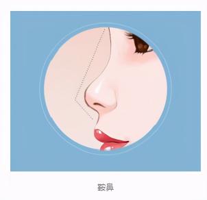 上海九院祛疤价格表（常见的这5种不良鼻型）