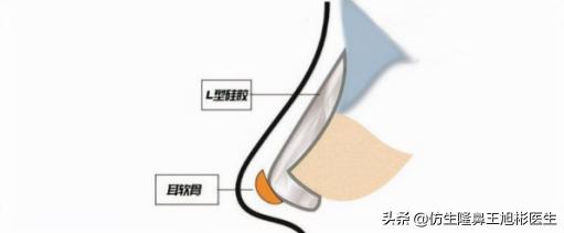 鼻综合修复价格（广州鼻修复）