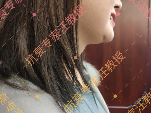 玻尿酸填充价格（听说你想用玻尿酸填充）