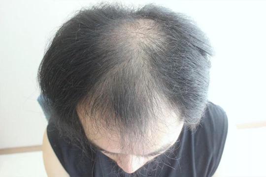 發際線值發需要多少錢(27歲小哥5級脫發被叫大叔)
