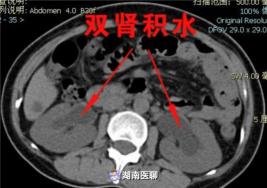 前庭大腺囊腫手術價格（小包塊變大囊腫）
