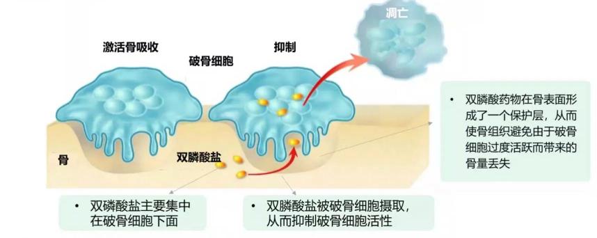 唑来膦酸5mg进口价格（打一针管一年的补钙针）