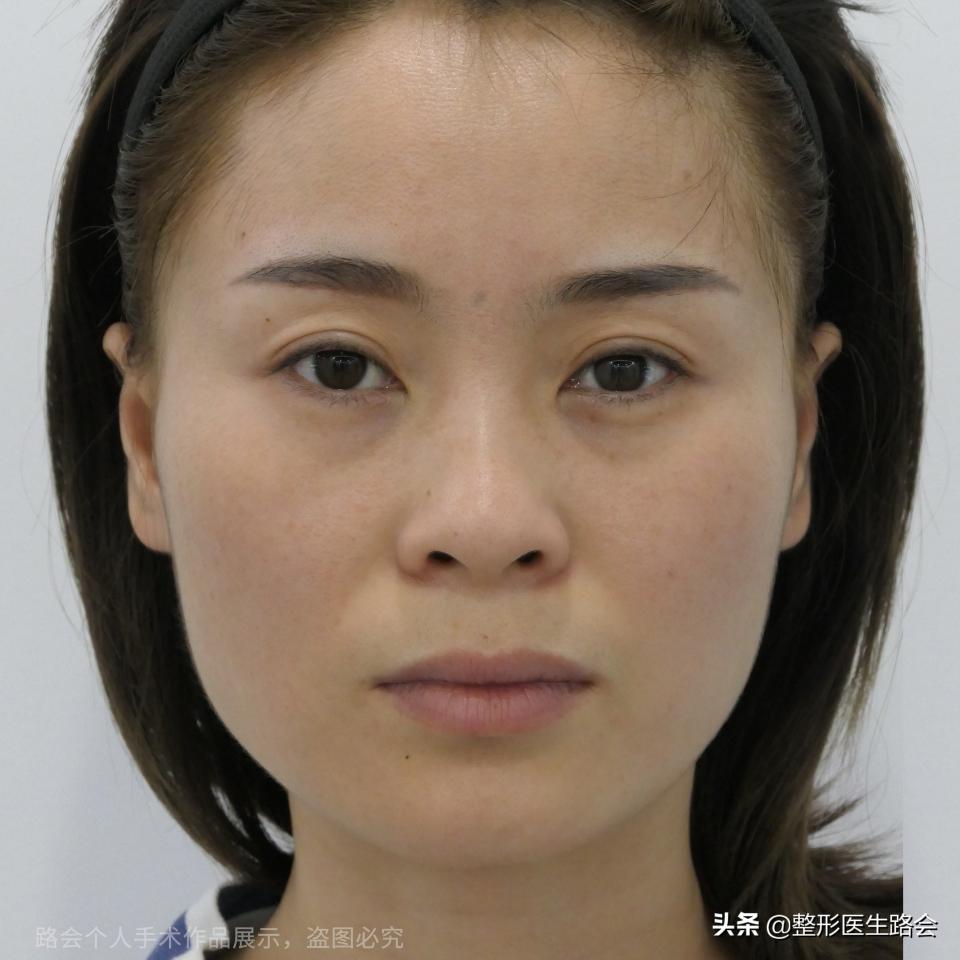 botox瘦脸针市场价格（我的青春不一样）